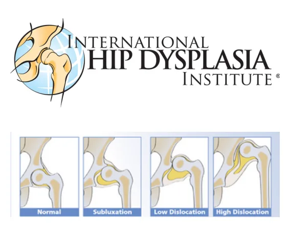 International Hip Dysplasia Institute: стадии на тазобедрената става